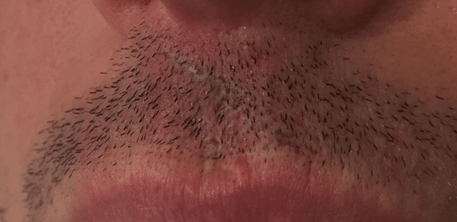 dit is een afbeelding van een bovenlip man, na behandeling medische tatoeage van het litteken. Deze is ingekleurd door Janny Hanegraaf van permanent mooi