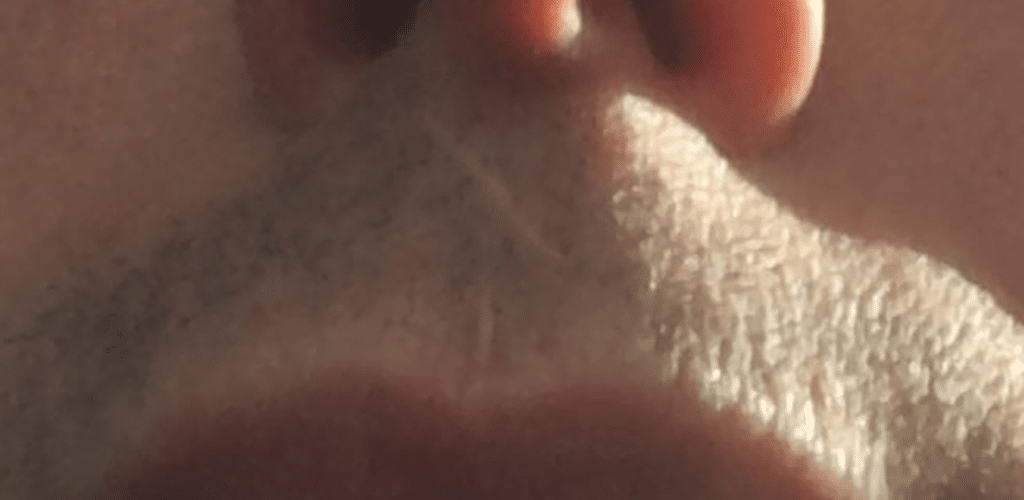 Dit is een afbeelding van een bovenlip met litteken in de snorharen. Deze heeft nog geen behandeling gehad van medische tatoege, litteken inkleuren