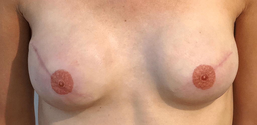 Dit is een afbeelding van voor een behandeling van twee borsten, de tepel is door borstreconstructie verwijderd na bijvoorbeeld borstkanker en heeft nog geen permanente make-up, door Permanent Mooi, medische tatoeage