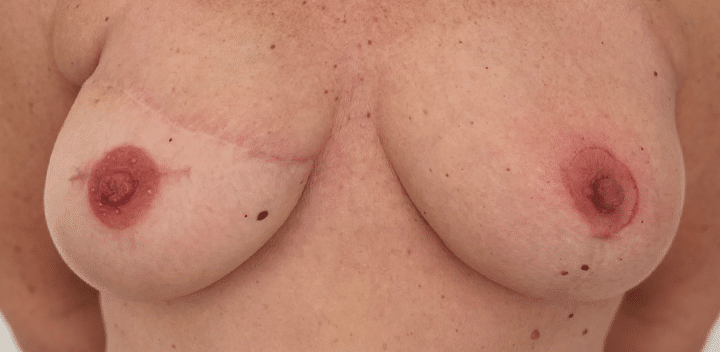 Afbeelding - voor behandeling medische tatoeage borst Permanent Mooi