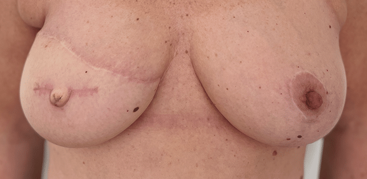 Afbeelding - voor behandeling medische tatoeage borst Permanent Mooi