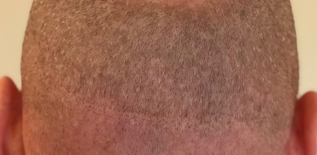 dit is een afbeelding van een achterhoofd van man met litteken, nog voor de behandeling medische tatoeage, litteken inkleuren.
