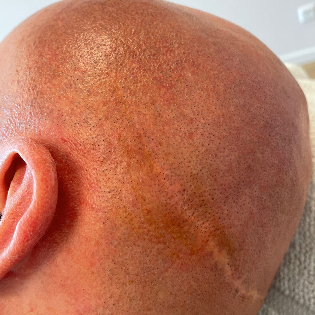 Werkwijze Dit is een afbeelding van een litteken op achterhoofd man