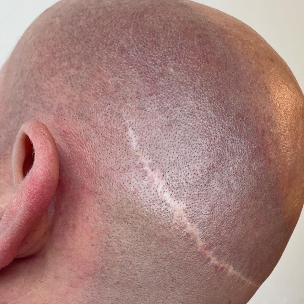 Werkwijze Dit is een afbeelding van een litteken op achterhoofd man