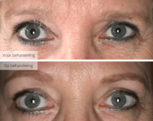 Voor en na wenkies, wenkbrauwen met permanente make-up in de overgang