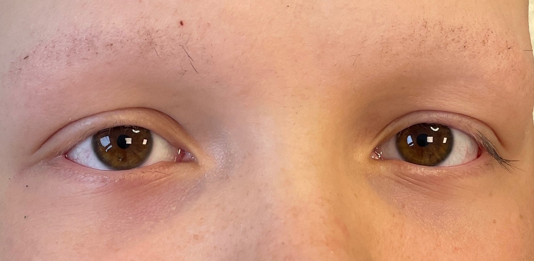 Dit is een beeld van ogen van een jongen voor behandeling wenkbrauwen permanente make-up Alopecia Behandeling