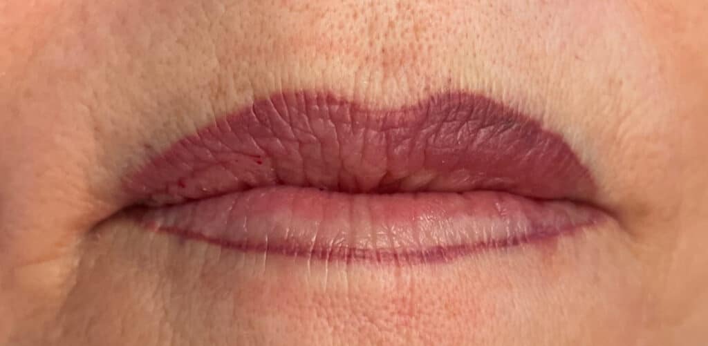 Lippen voor behandeling PMU