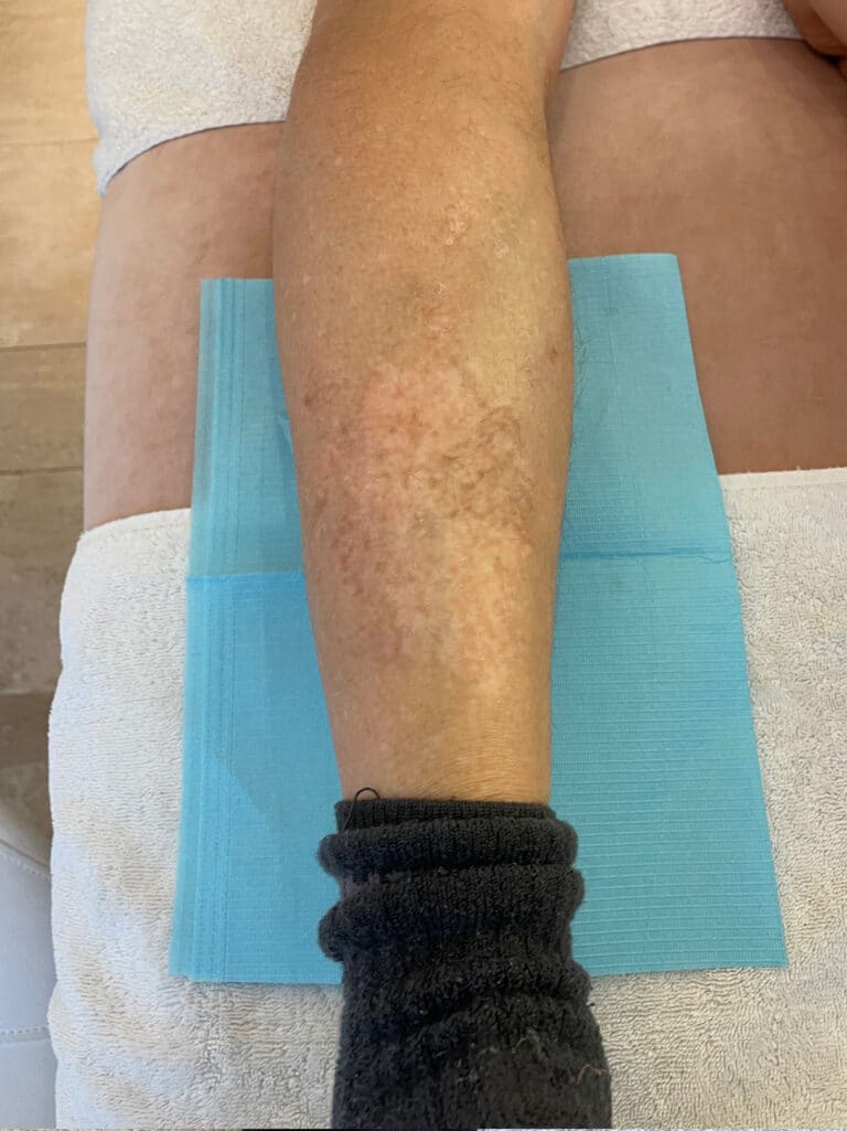 Camouflage van vitiligo na behandeling