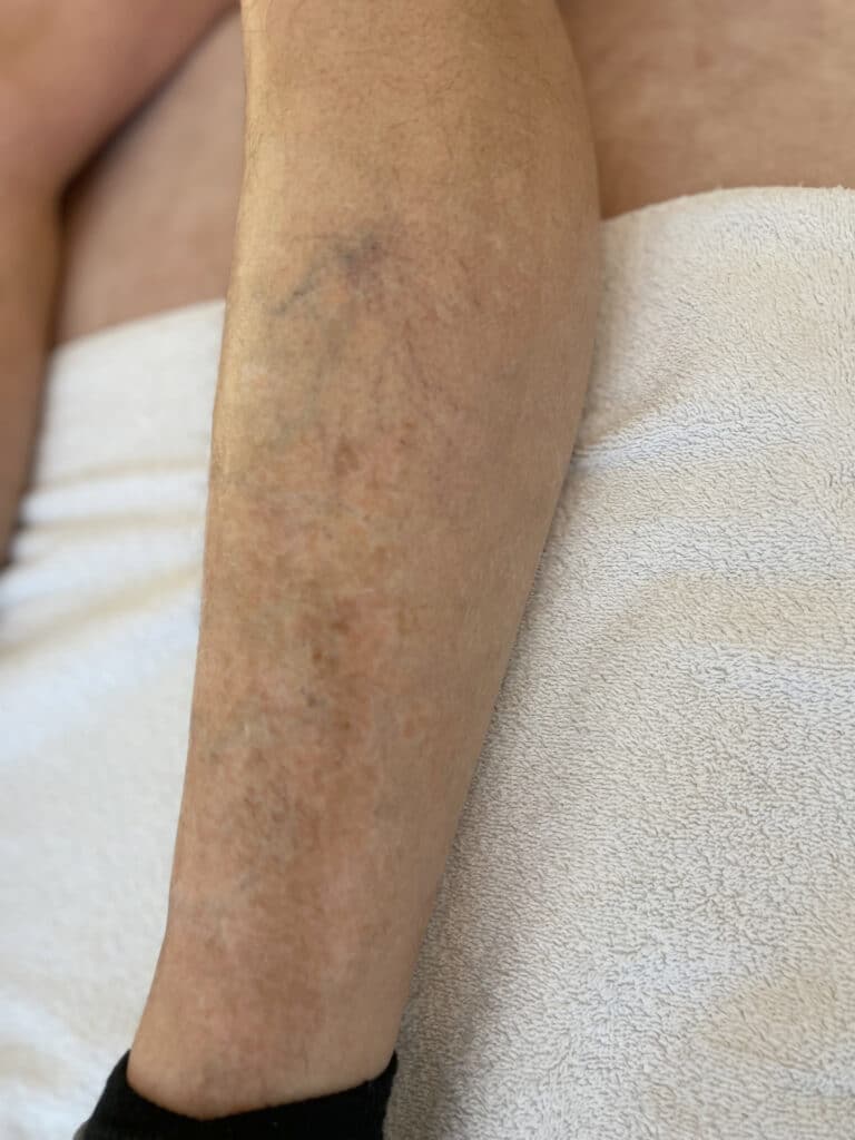 6 maanden na behandeling Vitiligo