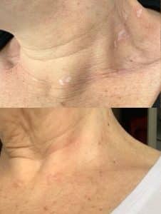Voor en na foto van een hals van vrouw met pigmentvlekken en erna met medische tatoeage