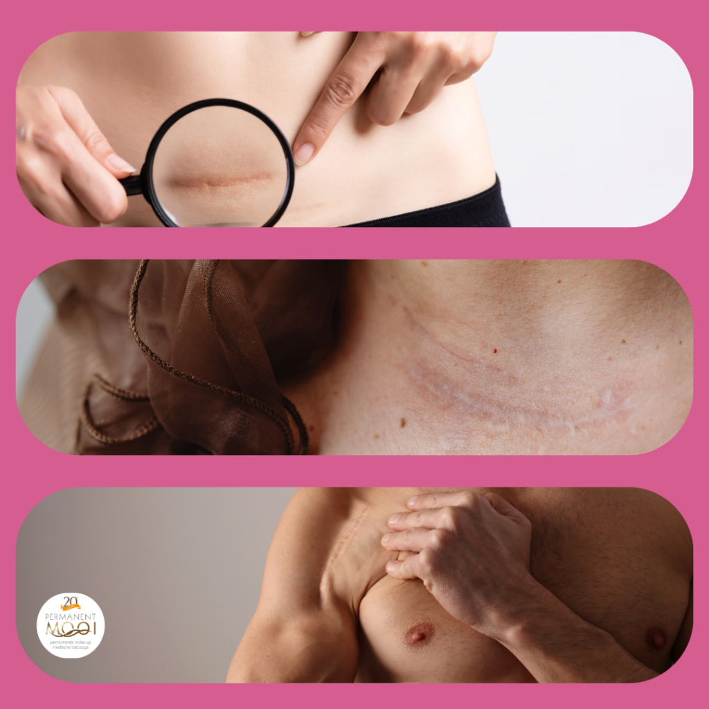 littekens inkleuren het kan met permanente make-up en medische tatoeage