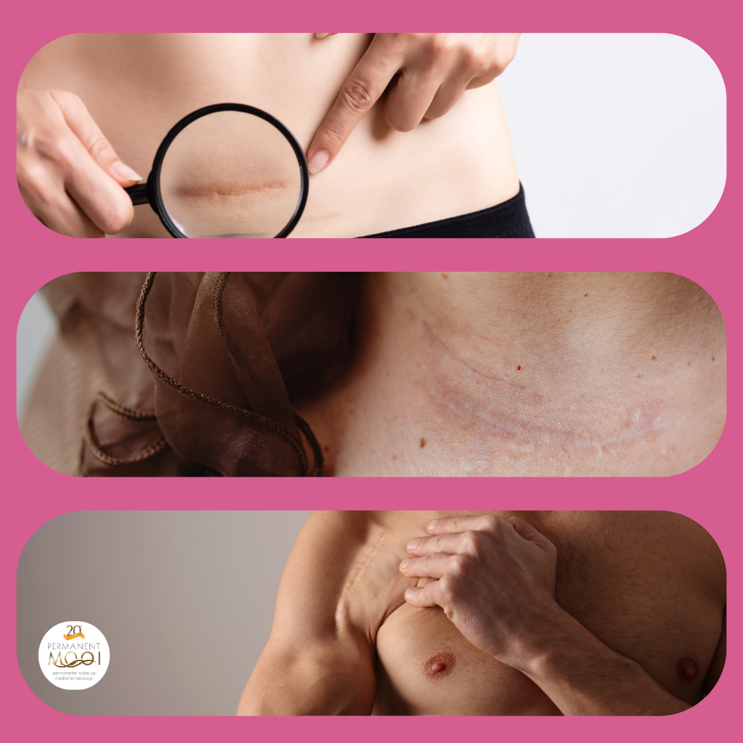 Inkleuren met permanente make-up is een oplossing voor littekens door brandwonden